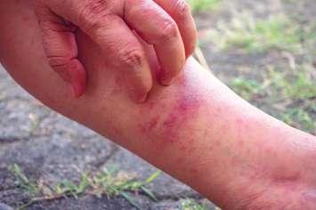 Measles rash. (Photo by Singjai20/iStock / Getty Images Plus)