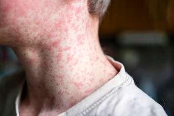 Measles rash. (Photo by Natalya Maisheva/iStock / Getty Images Plus)